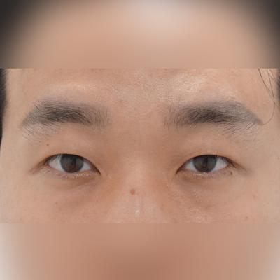 수술 1주차부터 일상생활 가능할 정도로 회복 잘 됐어요 사진 2 — 아바성형외과 기타 후기