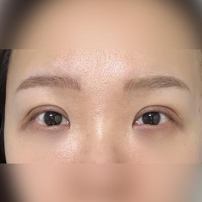 눈밑지방재배치 후기, 짝짝이 대칭 맞고 눈가가 환해졌어요 — 아바성형외과 환자 후기 사진