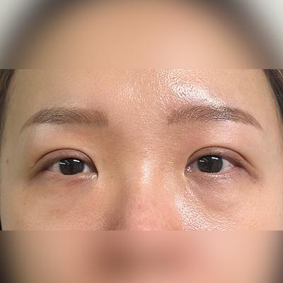 눈밑지방재배치 후기, 짝짝이 대칭 맞고 눈가가 환해졌어요 사진 2 — 아바성형외과 눈밑지방재배치 후기