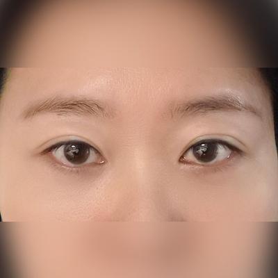 수술 6주차, 지금도 여전히 매끈해서 완전 만족스러워요 — 아바성형외과 환자 후기 사진
