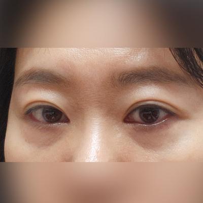 수술 6주차, 지금도 여전히 매끈해서 완전 만족스러워요 사진 2 — 아바성형외과 기타 후기