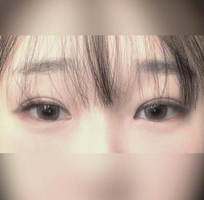 쌍꺼풀 절개 4주차, 원래 제 눈처럼 자연스럽게 잡혔어요 — 아바성형외과 환자 후기 사진