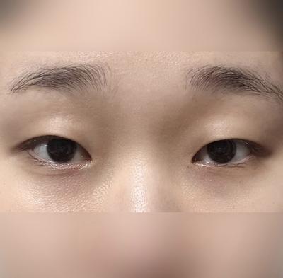 쌍꺼풀 절개 4주차, 원래 제 눈처럼 자연스럽게 잡혔어요 사진 2 — 아바성형외과 쌍꺼풀·눈성형 후기