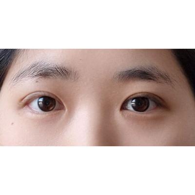 눈 수술 4주차, 자연스럽고 예쁜 눈매로 자리 잡아 완전 만족 — 아바성형외과 환자 후기 사진