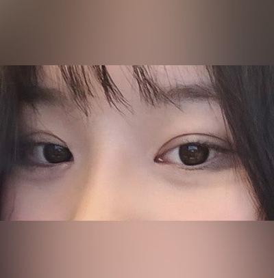 매몰쌍꺼풀 6주차, 단추구멍 같던 눈이 커졌어요 — 아바성형외과 환자 후기 사진