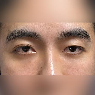 눈밑지방재배치 2주차, 짝짝이 대칭 맞고 눈가가 환해졌어요 — 아바성형외과 환자 후기 사진