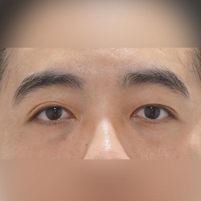 눈밑지방재배치 2주차, 짝짝이 대칭 맞고 눈가가 환해졌어요 사진 2 — 아바성형외과 눈밑지방재배치 후기