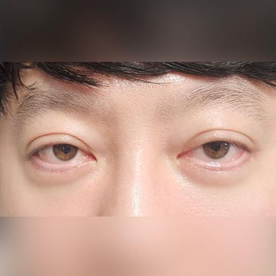 수술 후 경과 기록으로 남겨두는 짧은 후기입니다 — 아바성형외과 환자 후기 사진