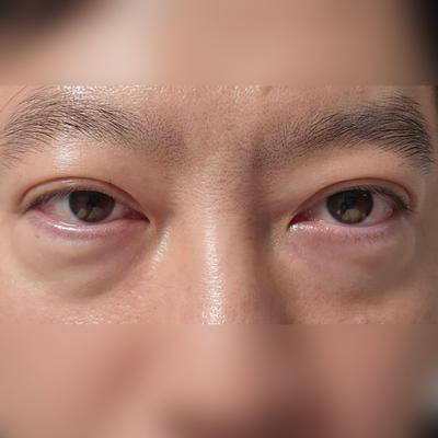 수술 후 경과 기록으로 남겨두는 짧은 후기입니다 사진 2 — 아바성형외과 기타 후기