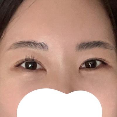 눈밑지방재배치, 몇 년 고민했는데 왜 이제 했나 싶어요 — 아바성형외과 환자 후기 사진