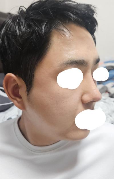 눈밑지방재배치에 코수술까지 6주차, 어두운 인상 개선 — 아바성형외과 환자 후기 사진
