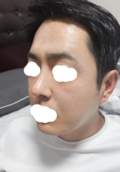 눈밑지방재배치에 코수술까지 6주차, 어두운 인상 개선 사진 5 — 아바성형외과 눈밑지방재배치 후기