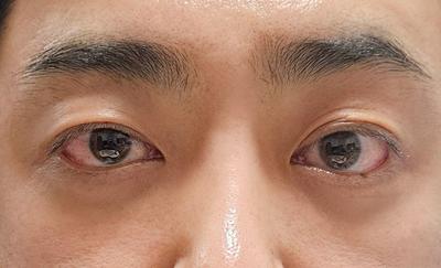 눈밑지방재배치에 코수술까지 6주차, 어두운 인상 개선 사진 6 — 아바성형외과 눈밑지방재배치 후기