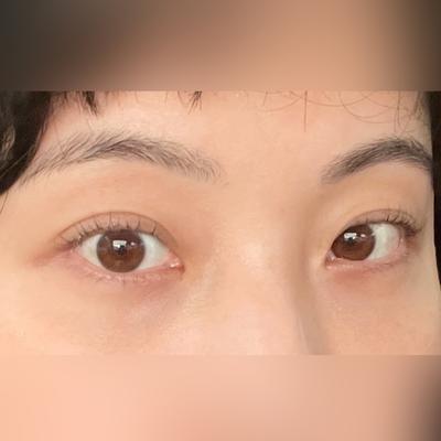 눈성형 환자 후기 — 브라운성형외과에서 김승수원장... (471)