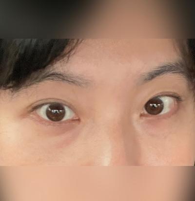 눈밑지방재배치 8주차, 다크서클 사라지고 확 어려졌어요 사진 2 — 아바성형외과 눈밑지방재배치 후기