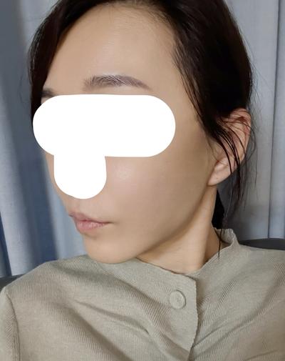아바성형외과에서 시술받고 남기는 짧은 후기 — 아바성형외과 환자 후기 사진