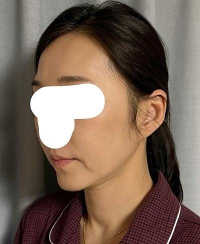 아바성형외과에서 시술받고 남기는 짧은 후기 사진 4 — 아바성형외과 기타 후기