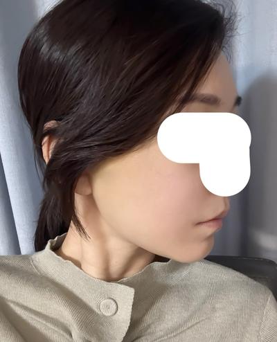 아바성형외과에서 시술받고 남기는 짧은 후기 사진 5 — 아바성형외과 기타 후기