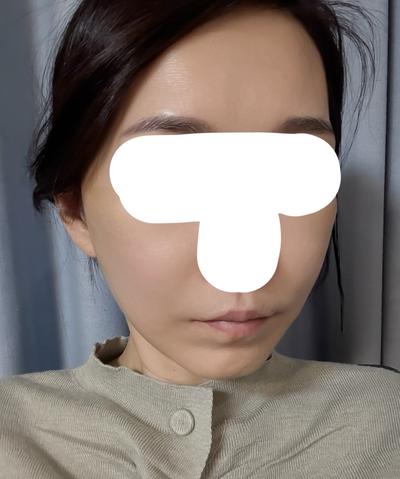 아바성형외과에서 시술받고 남기는 짧은 후기 사진 6 — 아바성형외과 기타 후기