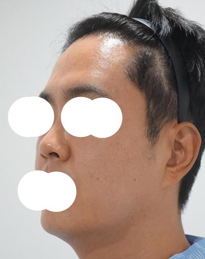눈밑지방재배치＋코수술 2주차, 인상이 확 깔끔해졌어요 사진 4 — 아바성형외과 눈밑지방재배치 후기