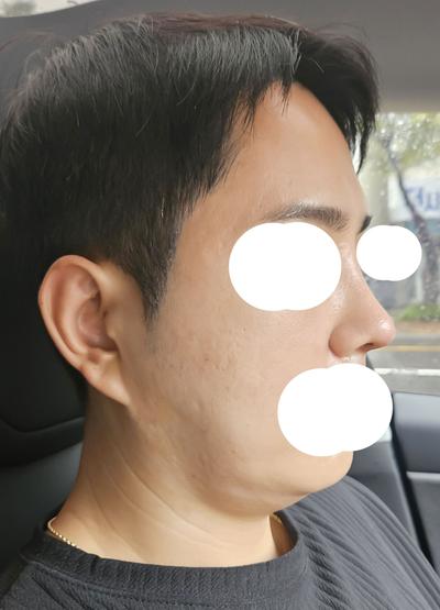 눈밑지방재배치＋코수술 2주차, 인상이 확 깔끔해졌어요 사진 5 — 아바성형외과 눈밑지방재배치 후기