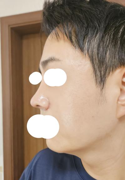 눈밑지방재배치＋코수술 2주차, 인상이 확 깔끔해졌어요 사진 6 — 아바성형외과 눈밑지방재배치 후기