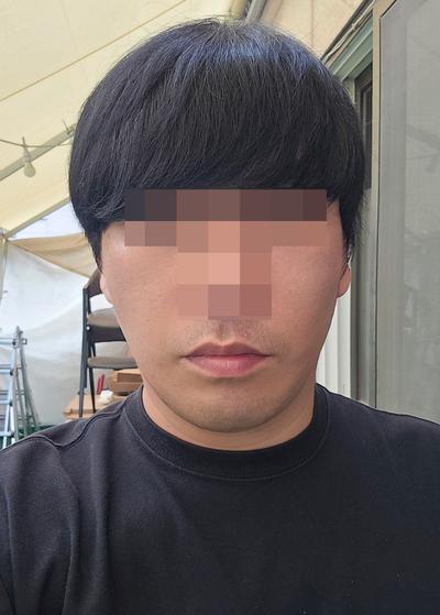 안면거상 후기, 처진 볼살 팔자주름 고민이라 결정했어요 — 아바성형외과 환자 후기 사진