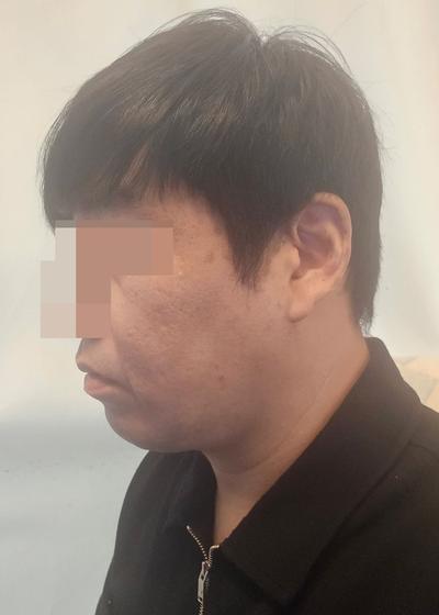 안면거상 후기, 처진 볼살 팔자주름 고민이라 결정했어요 사진 4 — 아바성형외과 안면거상 후기