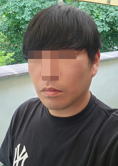 안면거상 후기, 처진 볼살 팔자주름 고민이라 결정했어요 사진 5 — 아바성형외과 안면거상 후기