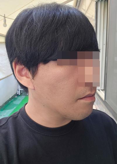 안면거상 후기, 처진 볼살 팔자주름 고민이라 결정했어요 사진 6 — 아바성형외과 안면거상 후기