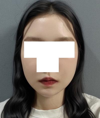 수술 7주차, 이중턱 아직 딱딱한데 지금도 만족해요 — 아바성형외과 환자 후기 사진