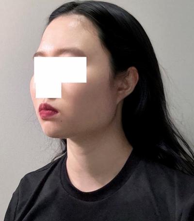 수술 7주차, 이중턱 아직 딱딱한데 지금도 만족해요 사진 4 — 아바성형외과 이중턱·윤곽 후기
