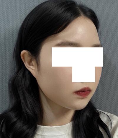 수술 7주차, 이중턱 아직 딱딱한데 지금도 만족해요 사진 5 — 아바성형외과 이중턱·윤곽 후기
