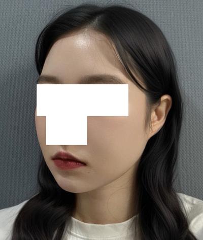 수술 7주차, 이중턱 아직 딱딱한데 지금도 만족해요 사진 6 — 아바성형외과 이중턱·윤곽 후기