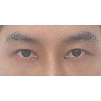 눈밑지방 고민 끝, 신논현 아바성형외과에서 수술했어요 — 아바성형외과 환자 후기 사진