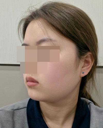 이중턱지방흡입 6주차, 얼굴형 자체가 완전 달라졌어요 — 아바성형외과 환자 후기 사진