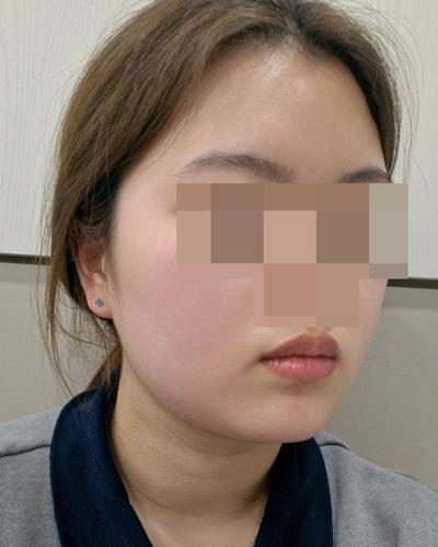 이중턱지방흡입 6주차, 얼굴형 자체가 완전 달라졌어요 사진 5 — 아바성형외과 이중턱·윤곽 후기
