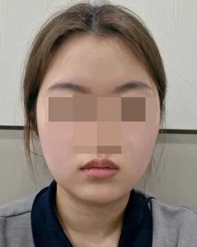 이중턱지방흡입 6주차, 얼굴형 자체가 완전 달라졌어요 사진 6 — 아바성형외과 이중턱·윤곽 후기