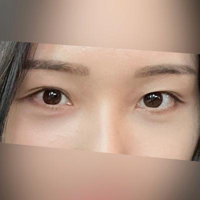 눈밑지방재배치 1개월차, 붓기 멍 다 빠졌고 계속 지켜봐요 — 아바성형외과 환자 후기 사진