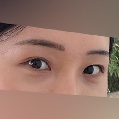 눈밑지방재배치 1개월차, 붓기 멍 다 빠졌고 계속 지켜봐요 사진 3 — 아바성형외과 눈밑지방재배치 후기