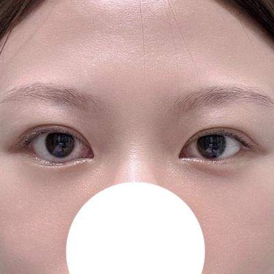 눈밑지방재배치 6주차, 툭 튀어나온 눈밑 개선돼서 너무 좋아요 — 아바성형외과 환자 후기 사진