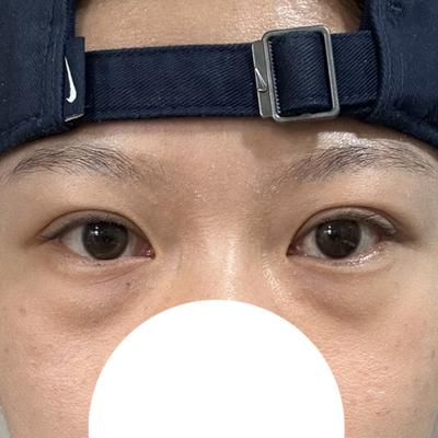 눈밑지방재배치 6주차, 툭 튀어나온 눈밑 개선돼서 너무 좋아요 사진 2 — 아바성형외과 눈밑지방재배치 후기