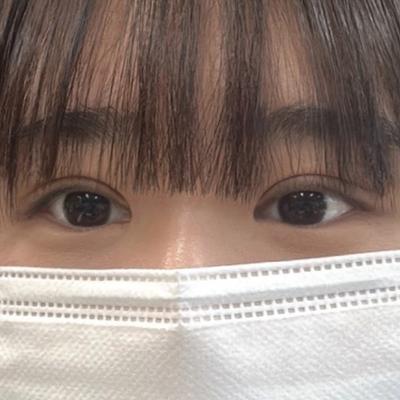 눈성형 후기, 눈 보정 안 해도 사진 잘 나와요 사진 5 — 아바성형외과 쌍꺼풀·눈성형 후기