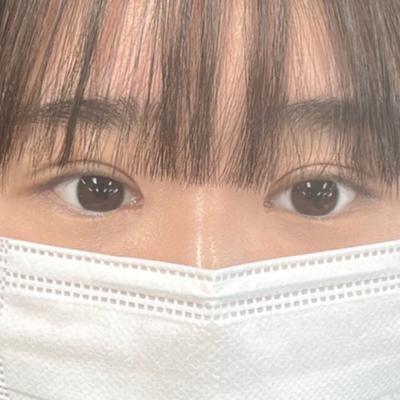 눈성형 후기, 눈 보정 안 해도 사진 잘 나와요 사진 8 — 아바성형외과 쌍꺼풀·눈성형 후기