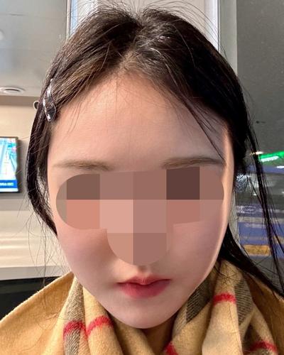 아큐 얼굴지방흡입 5주차, 턱선 정리되고 브이라인 또렷해졌어요 — 아바성형외과 환자 후기 사진