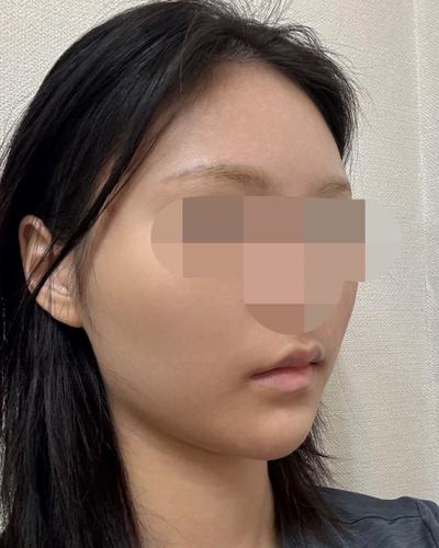 아큐 얼굴지방흡입 5주차, 턱선 정리되고 브이라인 또렷해졌어요 사진 3 — 아바성형외과 이중턱·윤곽 후기