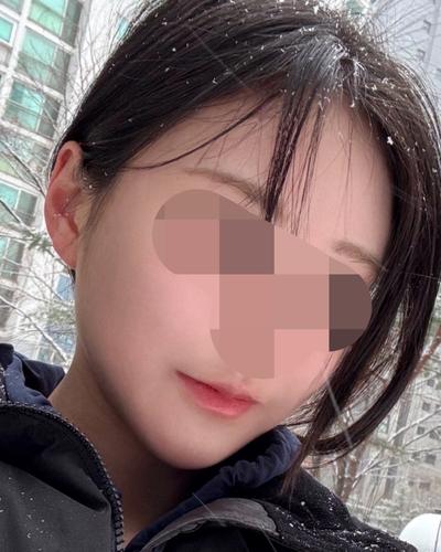 아큐 얼굴지방흡입 5주차, 턱선 정리되고 브이라인 또렷해졌어요 사진 5 — 아바성형외과 이중턱·윤곽 후기