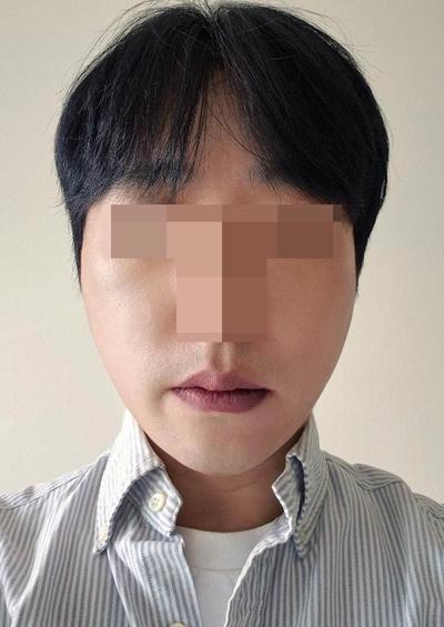 이마내시경거상 2주차, 미간주름 80프로 사라져 대만족 — 아바성형외과 환자 후기 사진