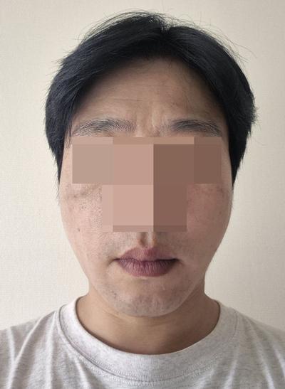 이마내시경거상 2주차, 미간주름 80프로 사라져 대만족 사진 2 — 아바성형외과 안면거상 후기