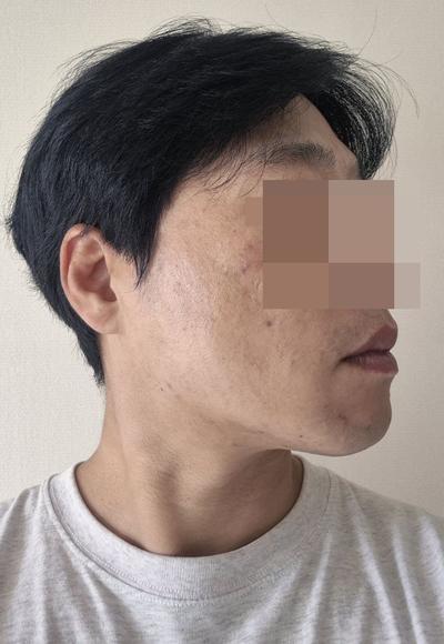 이마내시경거상 2주차, 미간주름 80프로 사라져 대만족 사진 3 — 아바성형외과 안면거상 후기